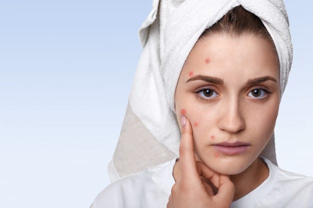 dicas para tratar e prevenir a acne