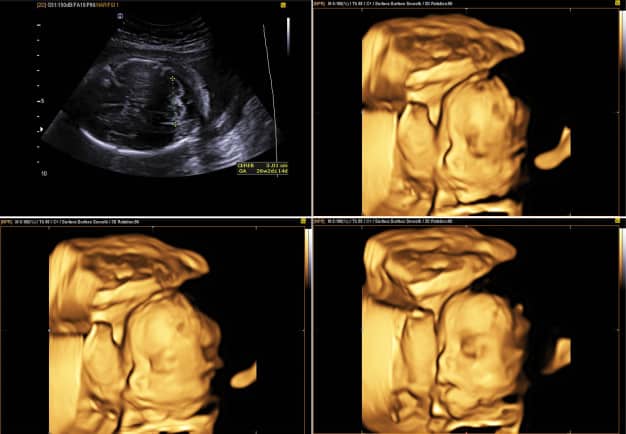 bebê em imagem de ultrassom